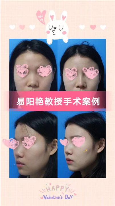易阳艳医生做鼻子怎么样