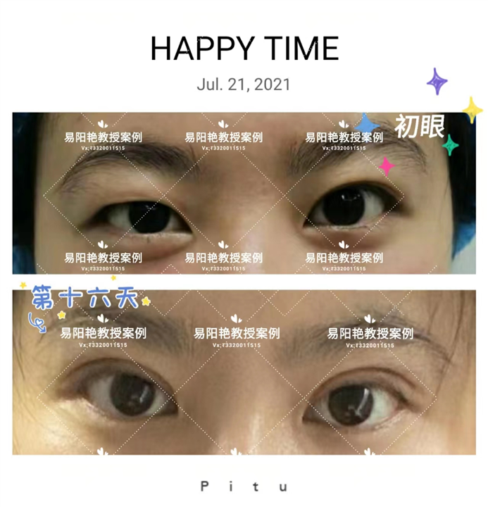 南昌易阳艳割双眼皮