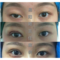 易阳艳双眼皮手术案例