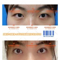 易阳艳双眼皮手术案例