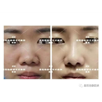 易阳艳医生做鼻子怎么样