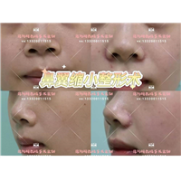 南昌易阳艳医生鼻整形