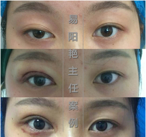 易阳艳双眼皮手术案例