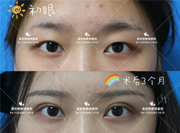南昌易阳艳割双眼皮怎么样