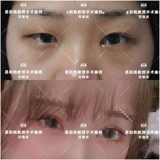 南昌易阳艳割双眼皮