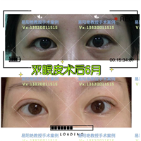 南昌易阳艳双眼皮手术案例
