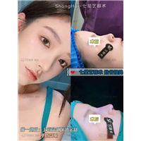 上海鼻整形 