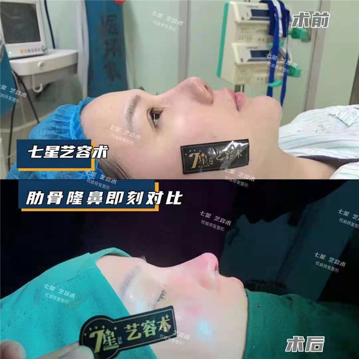 上海七星艺容术肋骨隆鼻整形 