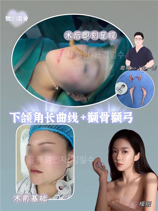金一秀磨骨怎么样 