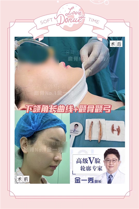 上海磨骨整形医院 