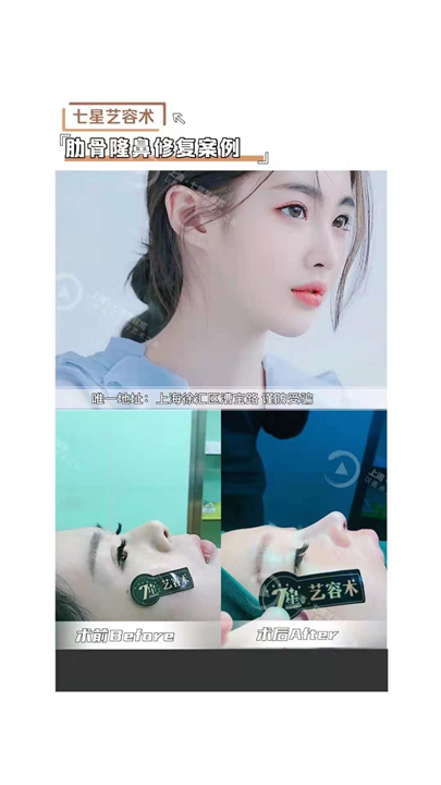 上海七星肋软骨隆鼻整形 