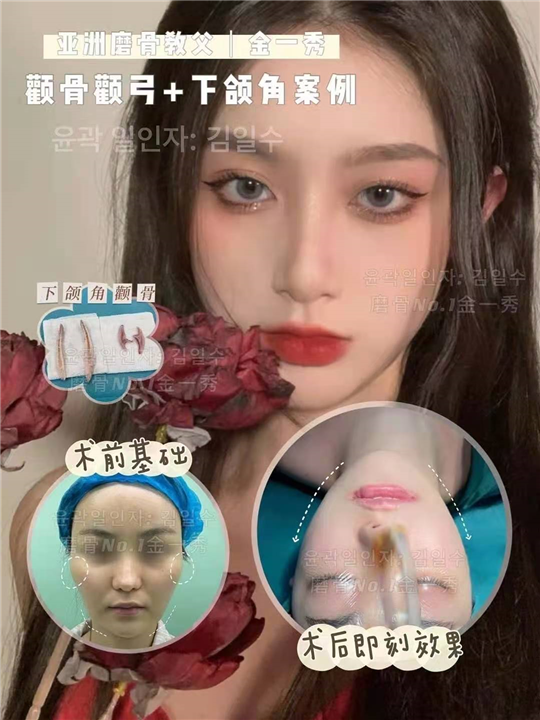 上海磨骨整形医院哪家好 