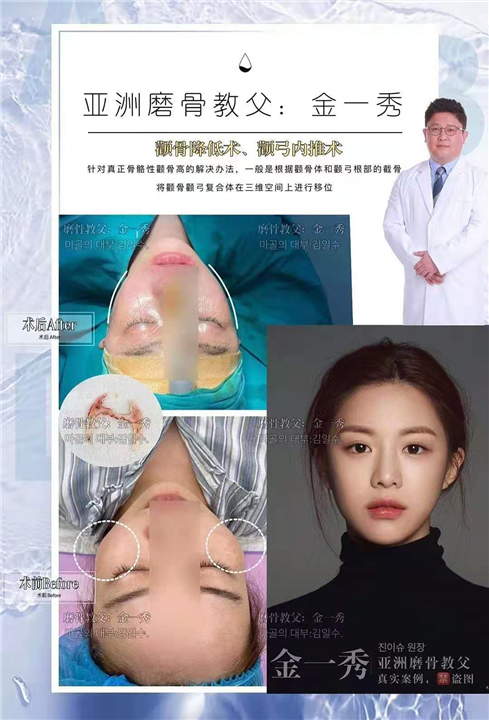 金一秀磨骨案例 