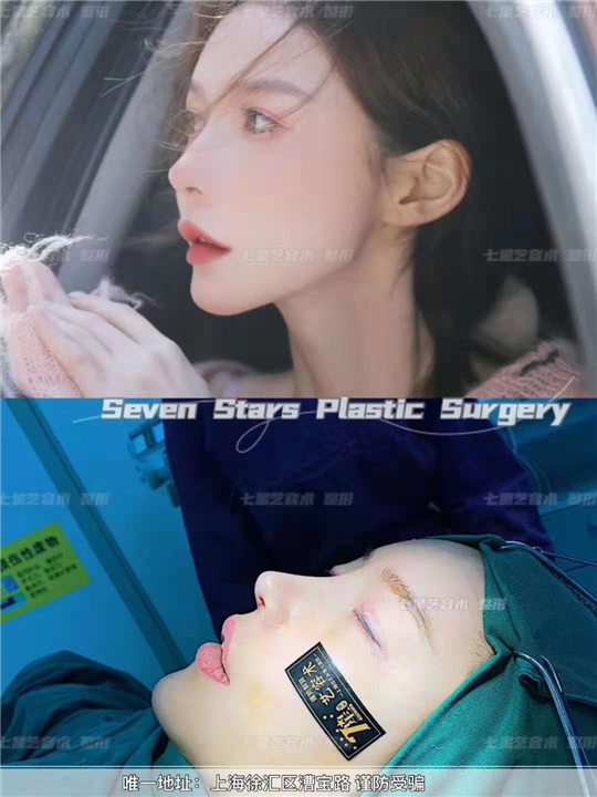 上海七星艺容术鼻整形 
