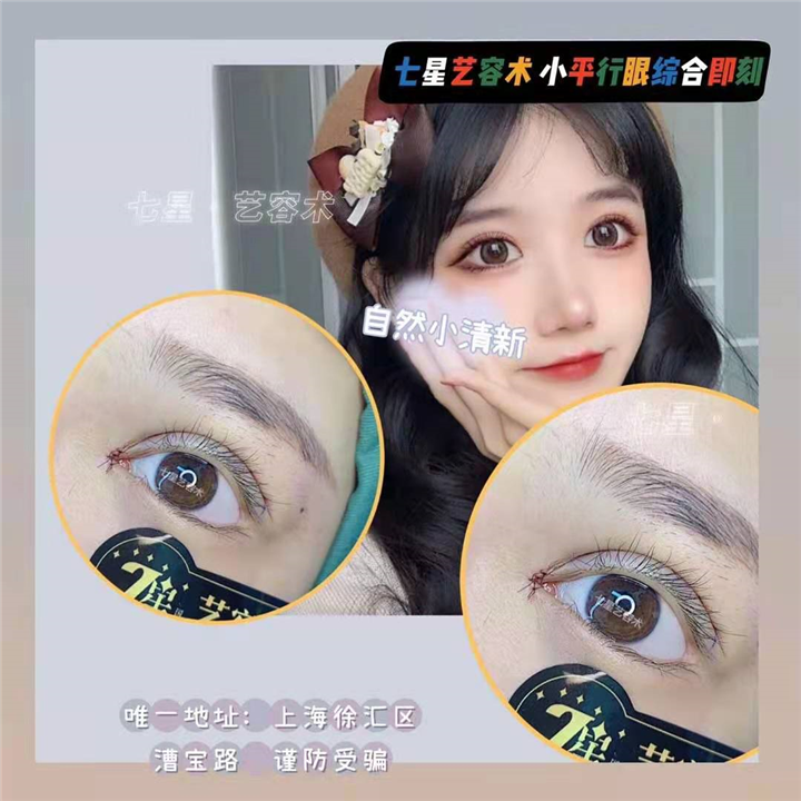 上海七星艺容术小眼综合整形 