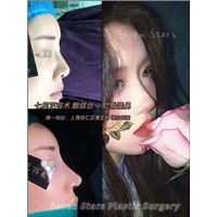 上海鼻综合整形 