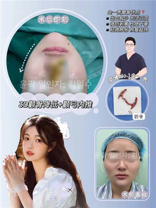 上海金一秀磨骨专家 