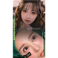 上海七星艺容术眼综合案例 