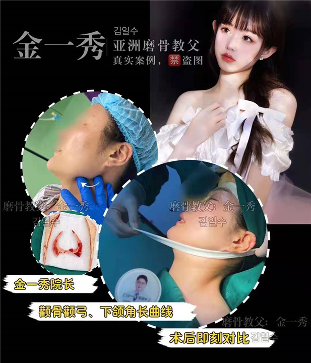 上海金一秀磨骨整形 