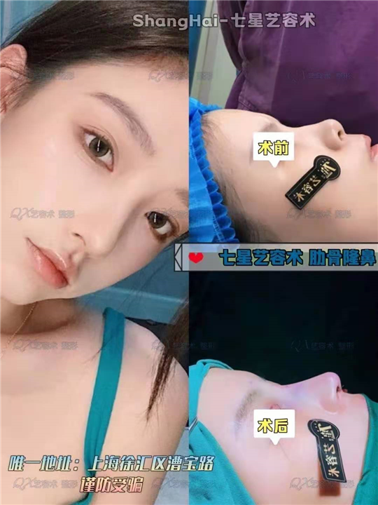 上海鼻整形 