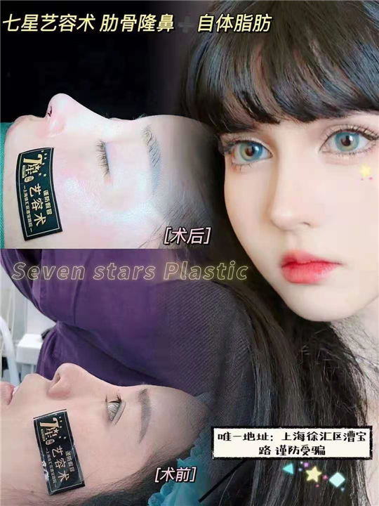 上海七星整形肋骨隆鼻 