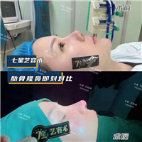 上海七星艺容术肋骨隆鼻整形 