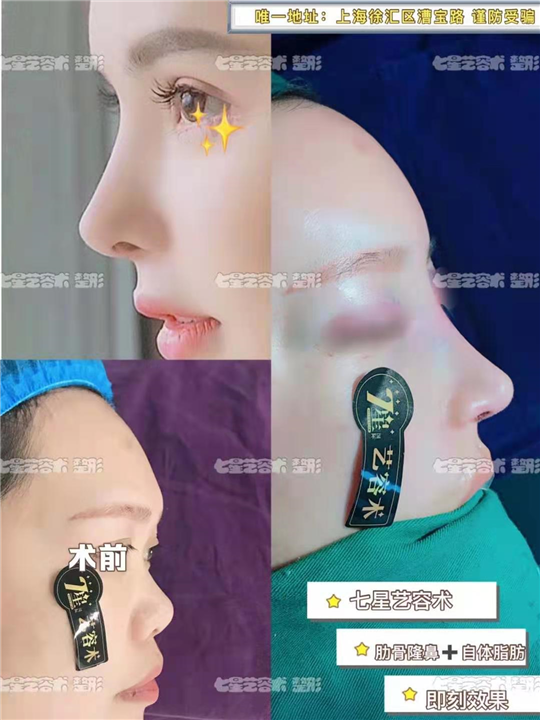 七星艺容术肋骨鼻整形 