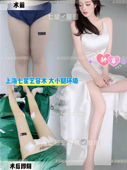 上海七星艺容术吸脂整形 