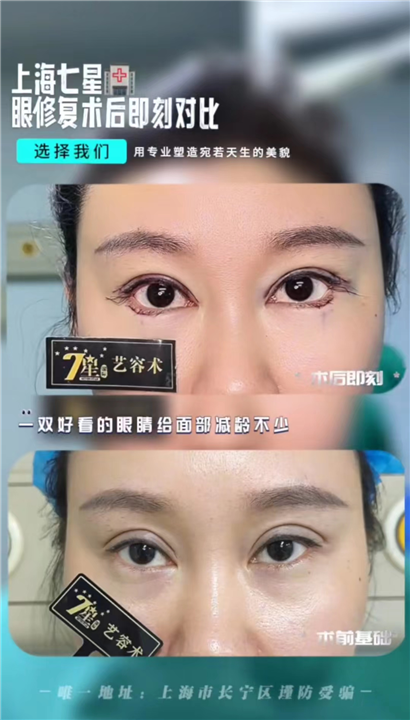 上海七星艺容术眼综合修复