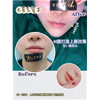 上海七星艺容术厚唇改薄 