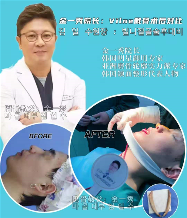 上海磨骨整形医生推荐 