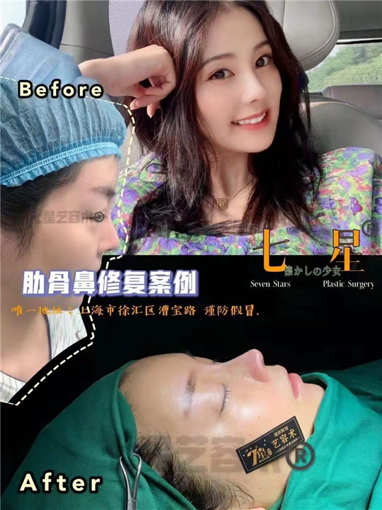 上海肋骨鼻整形医院 