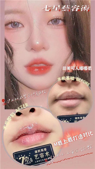 上海m唇整形 