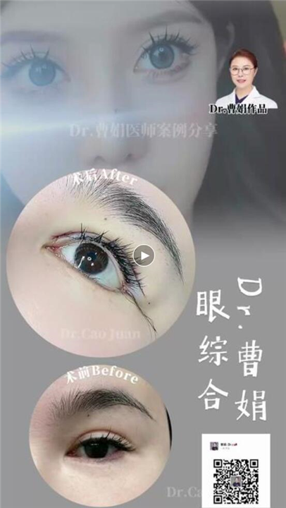 曹娟医生眼部案例