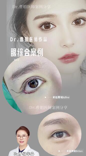 如果埋线双眼皮和切开双眼皮都可以