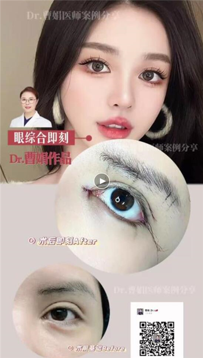 曹娟医生眼部案例