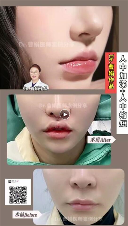 曹娟医生人中案例