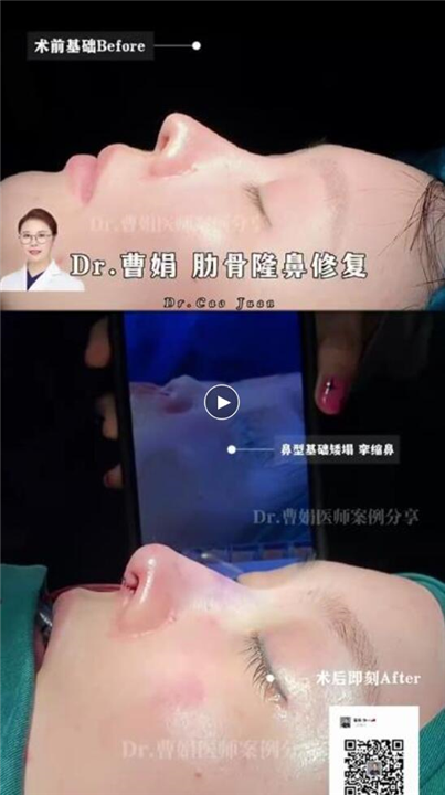 曹娟医生鼻部案例展示