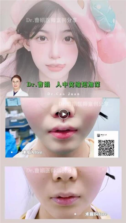 曹娟医生人中案例