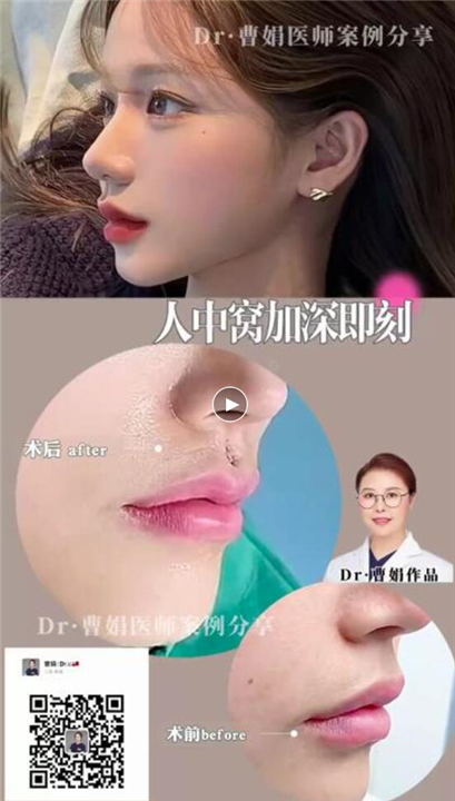 曹娟医生人中案例