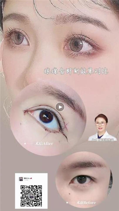曹娟医生眼部案例