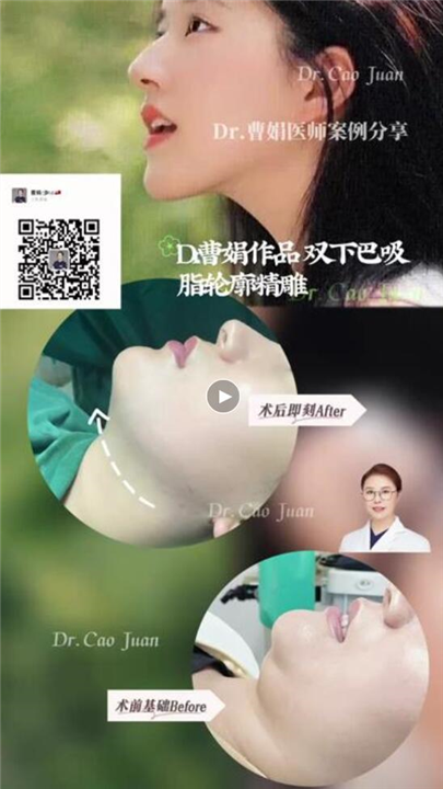 曹娟医生下巴案例