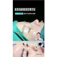 鼻部多项手术比单纯隆鼻更好