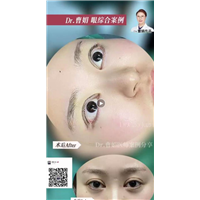 曹娟医生眼部案例