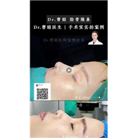 上海曹娟整形医生鼻部案例