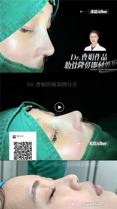 上海曹娟整形医生鼻部案例