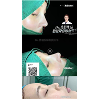 上海曹娟整形医生鼻部案例