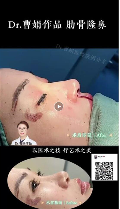 上海曹娟整形医生鼻部案例