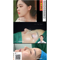 上海曹娟整形医生鼻部案例