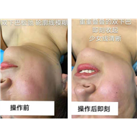 剥离微整下颚线